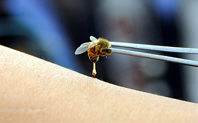 蜂疗治疗类风湿性关节炎介绍图片